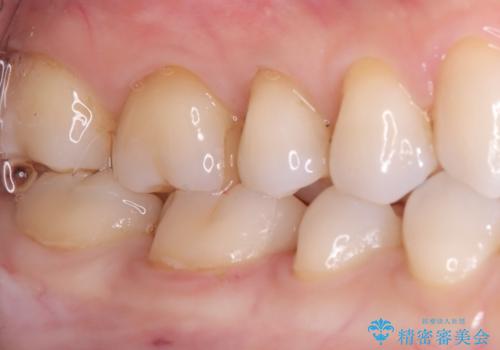 【セラミックインレー】歯がたまーにしみるの治療後
