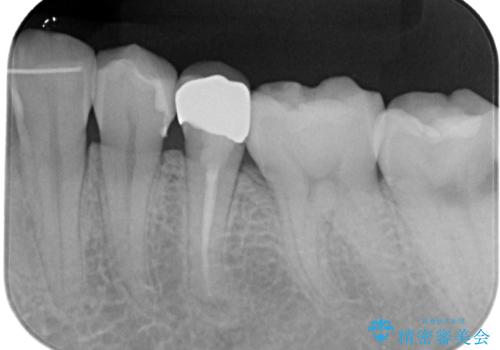被せものが割れた オールセラミッククラウン・セラミックインレー修復の治療後