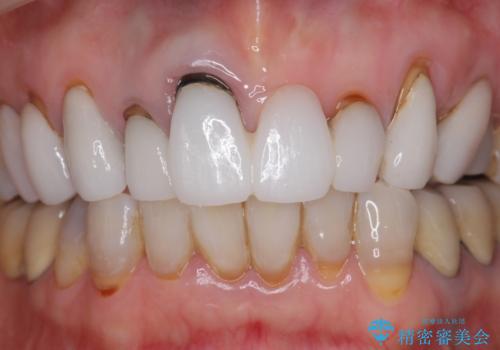 [ セラミック治療 ]  歯ぐきの際の黒ずみを改善したいの治療前