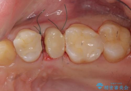 歯の水平・垂直的位置を整備したセラミッククラウン治療の治療中