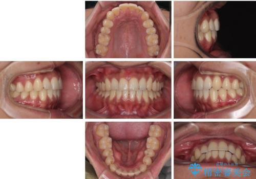 矯正後の後戻りをインビザラインライトで再治療|目立たない矯正の症例紹介の治療後