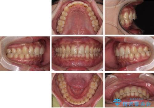 目立たない矯正で正中離開と下の前歯のデコボコを改善|インビザラインによる治療症例の治療後