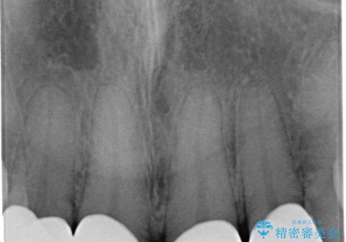 前歯の劣化したコンポジットレジン修復をセラミッククラウンへの治療後