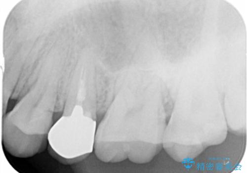 歯の水平・垂直的位置を整備したセラミッククラウン治療の治療前