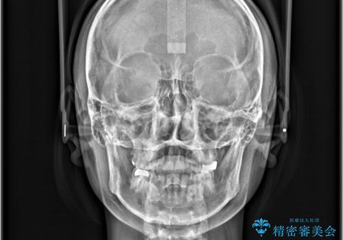 すきっ歯・切端咬合・空隙歯列|インビザラインで11ヵ月で治療完了の治療前