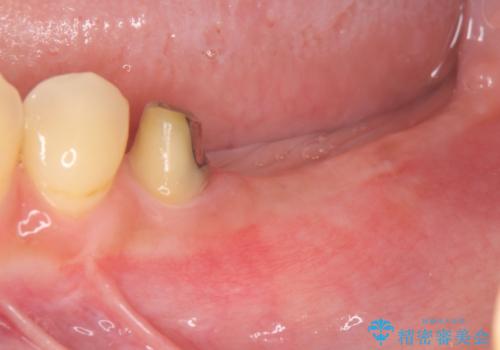 遊離歯肉移植術を併用した、破折歯のインプラント治療の治療中