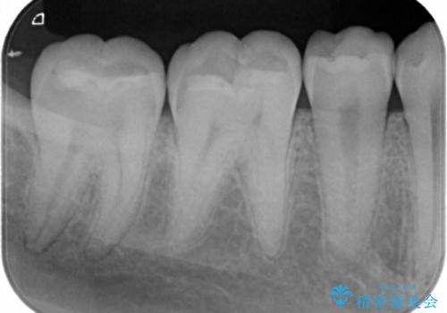 奥歯の治療をしたい セラミックインレーの治療前