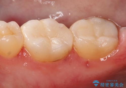 奥歯の治療をしたい セラミックインレーの治療後
