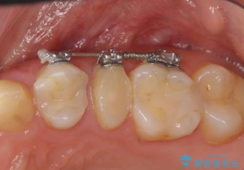 歯の水平・垂直的位置を整備したセラミッククラウン治療の治療中