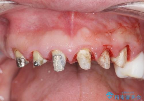 [ 歯周外科手術 ]  セラミック治療後の歯ぐきの違和感の治療中