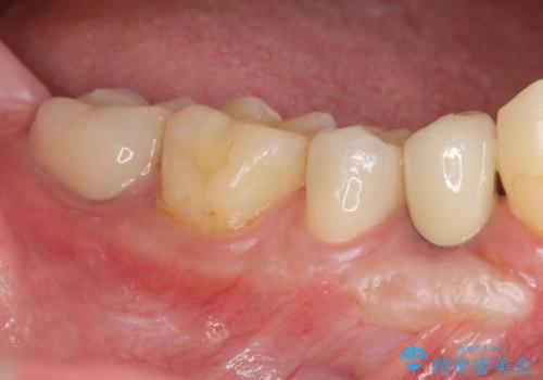 すべての虫歯治療をしたいの症例 治療後