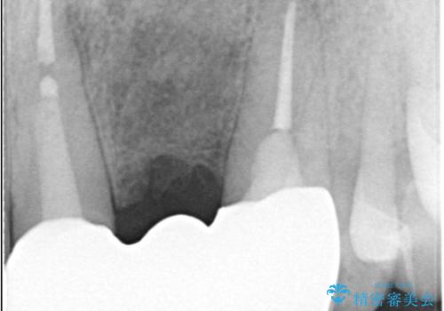 【セラミッククラウン】【エクストリュージョン】抜歯はしたくないの治療後