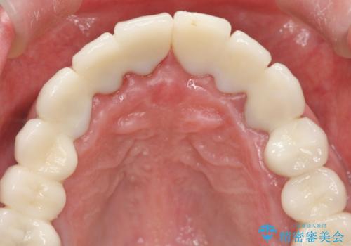 [ 歯周外科手術 ]  セラミック治療後の歯ぐきの違和感の治療前