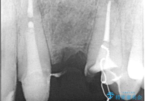 【セラミッククラウン】【エクストリュージョン】抜歯はしたくないの治療中