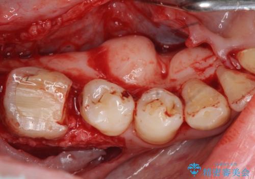 { 歯周外科 } 骨隆起除去を含む歯冠長延長術の治療中