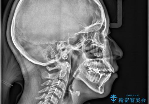 開咬・叢生(八重歯)を抜歯矯正で改善|ワイヤー矯正(クリア装置)症例の治療前