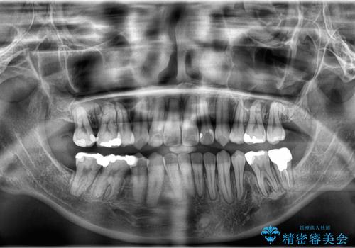 開咬・叢生(八重歯)を抜歯矯正で改善|ワイヤー矯正(クリア装置)症例の治療後