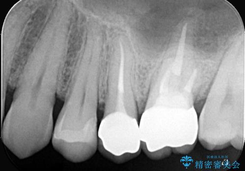 全ての銀歯をセラミックへ。お口全体をメタルフリーにして笑顔まで明るくの治療後
