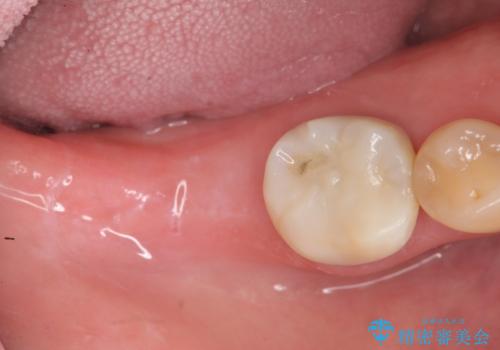 咬合機能を回復する奥歯のインプラント治療の治療前