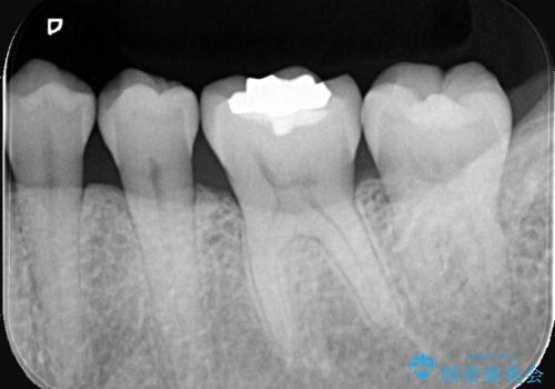 銀歯の段差と虫歯リスクを改善|ラバーダム防湿下で行うセラミックインレー治療の治療前