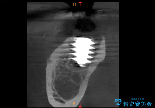 歯根嚢胞と瘻孔を伴う奥歯を抜歯即時インプラントで治療|一回の手術で改善!|インプラントの治療期間3か月の治療後
