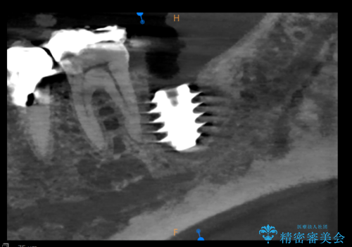 歯根嚢胞と瘻孔を伴う奥歯を抜歯即時インプラントで治療|一回の手術で改善!|インプラントの治療期間3か月の治療後