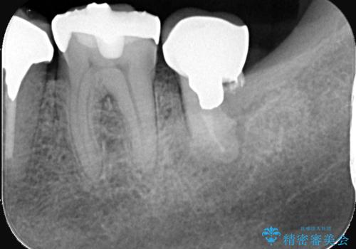 歯根嚢胞と瘻孔を伴う奥歯を抜歯即時インプラントで治療|一回の手術で改善!|インプラントの治療期間3か月の治療前