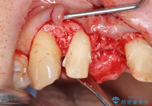 [ 再生療法 ]  歯周病治療を行った前歯のセラミック治療の治療前