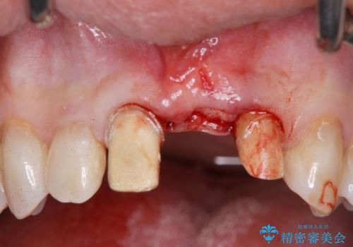 [ 欠損部の著しい骨欠損 ]　歯ぐきのボリュームを回復し自然なブリッジ作製治療の治療中