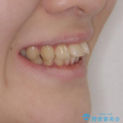 深い咬み合わせと飛び出した前歯 ワイヤー装置での抜歯矯正治療の治療前(顔貌)