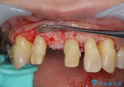 [ 再生療法 ]  歯周病治療を行った前歯のセラミック治療の治療中