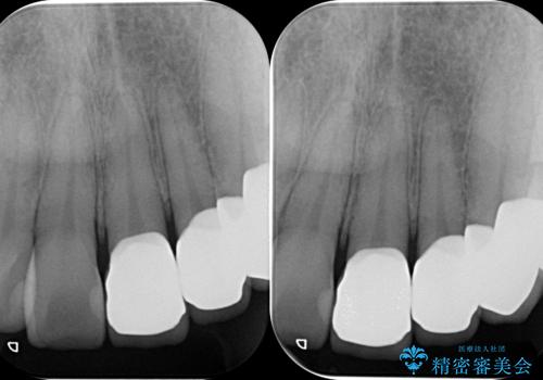 前歯の歯間に発生した虫歯のセラミック治療の治療後