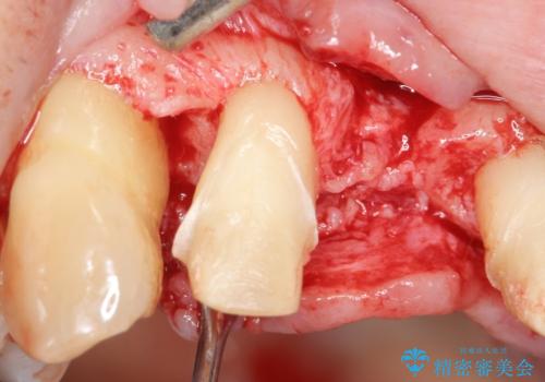 [ 再生療法 ]  歯周病治療を行った前歯のセラミック治療の治療前