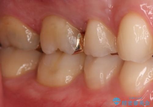銀歯を金歯にしたい ゴールドインレーの治療後