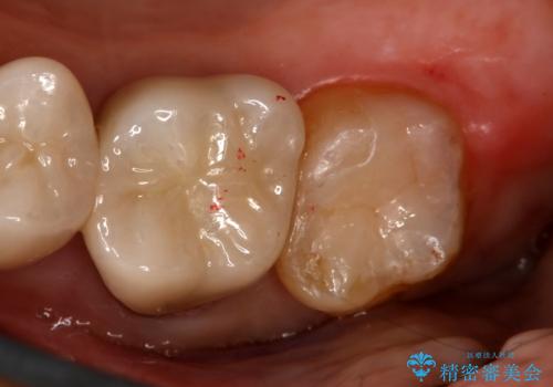 銀歯をやり変えたい　セラミックインレーの症例 治療後