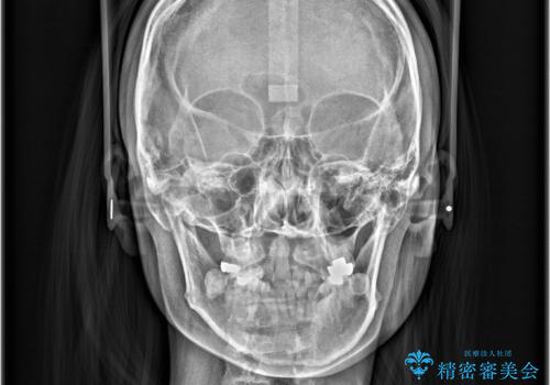【ワイヤー矯正】口元を下げたい、下の歯の凹凸を無くしたいの治療前