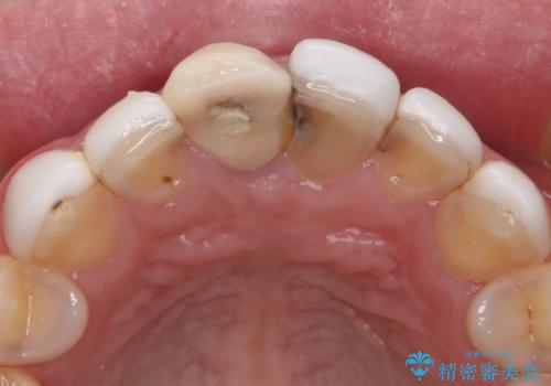 【オールセラミッククラウン】歯の色を合わせたいの治療前