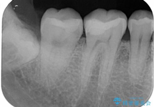 奥歯を良いもので治したい　セラミックインレーの治療後