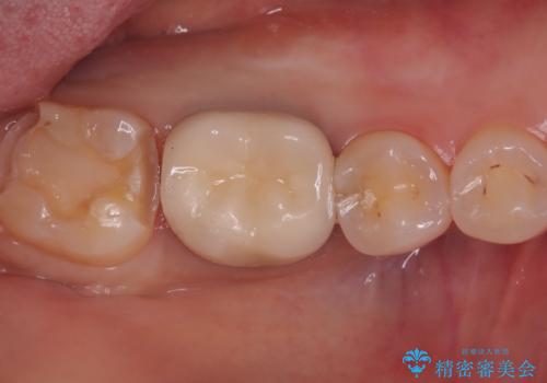 【セラミックインレー】歯の奥側に虫歯ができてしまったの治療中