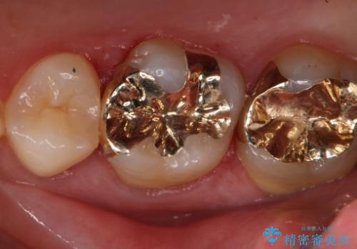 銀歯を金歯にしたい ゴールドインレーの治療後