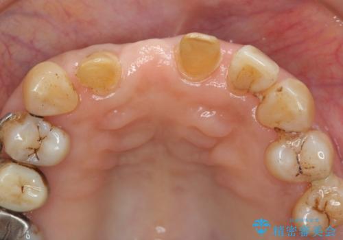 [ 再生療法 ]  歯周病治療を行った前歯のセラミック治療の治療中