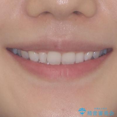 前歯のデコボコと小さい歯を改善 インビザラインとオールセラミッククラウンの治療前(顔貌)