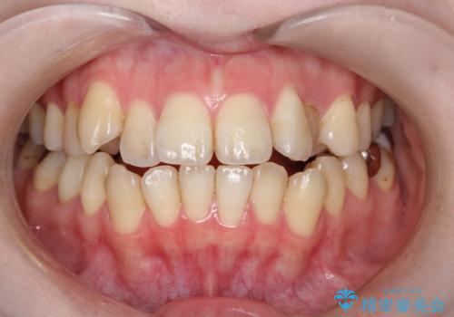 開咬・叢生(八重歯)を抜歯矯正で改善|ワイヤー矯正(クリア装置)症例の症例 治療前