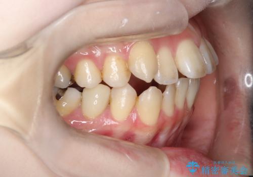 開咬・叢生(八重歯)を抜歯矯正で改善|ワイヤー矯正(クリア装置)症例の治療前