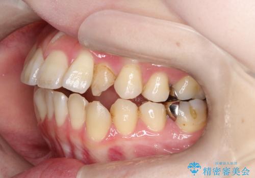 開咬・叢生(八重歯)を抜歯矯正で改善|ワイヤー矯正(クリア装置)症例の治療前