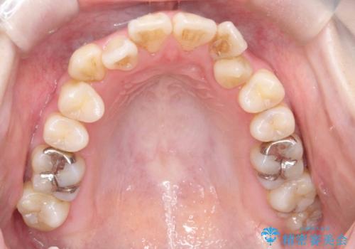 開咬・叢生(八重歯)を抜歯矯正で改善|ワイヤー矯正(クリア装置)症例の治療前
