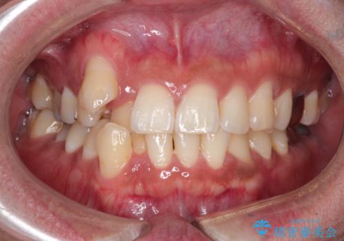 【ワイヤー矯正】八重歯と下の歯の凸凹を治したいの治療前