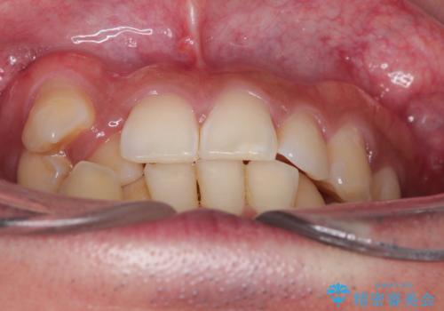 【ワイヤー矯正】八重歯と下の歯の凸凹を治したいの治療前