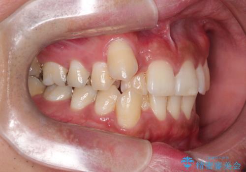 【ワイヤー矯正】八重歯と下の歯の凸凹を治したいの治療前