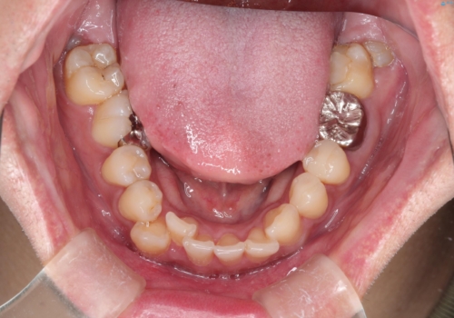 【ワイヤー矯正】八重歯と下の歯の凸凹を治したいの治療前